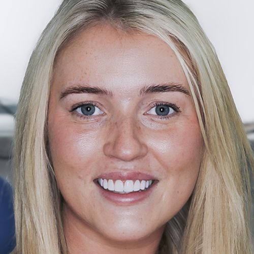 Orla - composite bonding - after - Carmen - 3dental